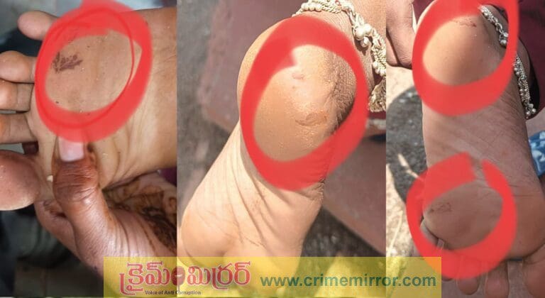 ఎలుకల కాట్లు .. విద్యార్థులకు ఘాట్లు…!