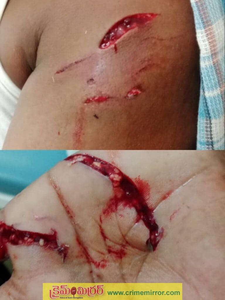 యువకుడి పై కోతులు దాడులు..