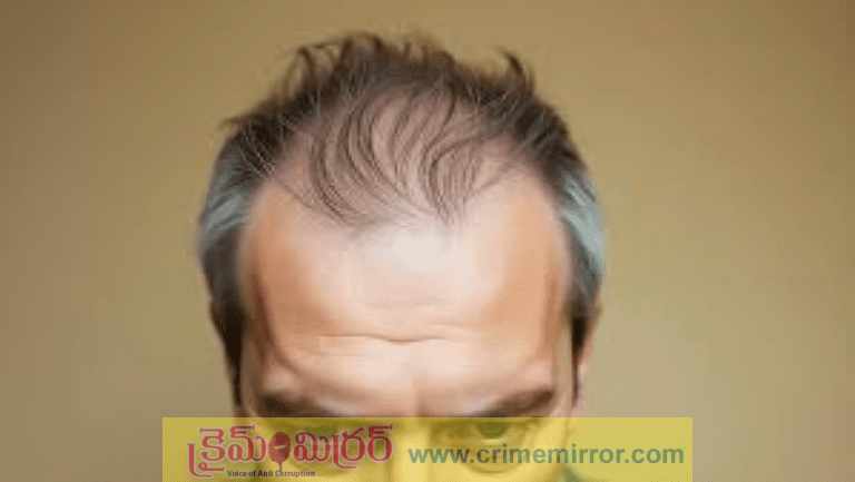 హస్త ప్రయోగం వల్ల జుట్టు రాలిపోతుందా?