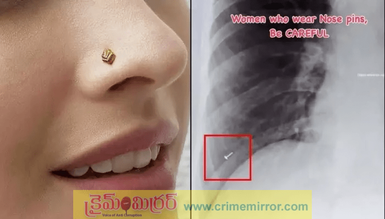 Shocking X-ray: ప్రాణం మీదకు తెచ్చిన ముక్కుపుడక!