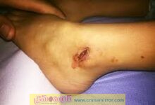 స్కూలు విద్యార్థినిపై కోతుల దాడి