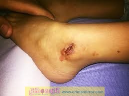 స్కూలు విద్యార్థినిపై కోతుల దాడి