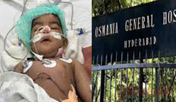 ఉస్మానియా అరుదైన స‌ర్జ‌రీ...చిన్నారికి లివ‌ర్ ట్రాన్స్‌ప్లాంటేష‌న్‌...!